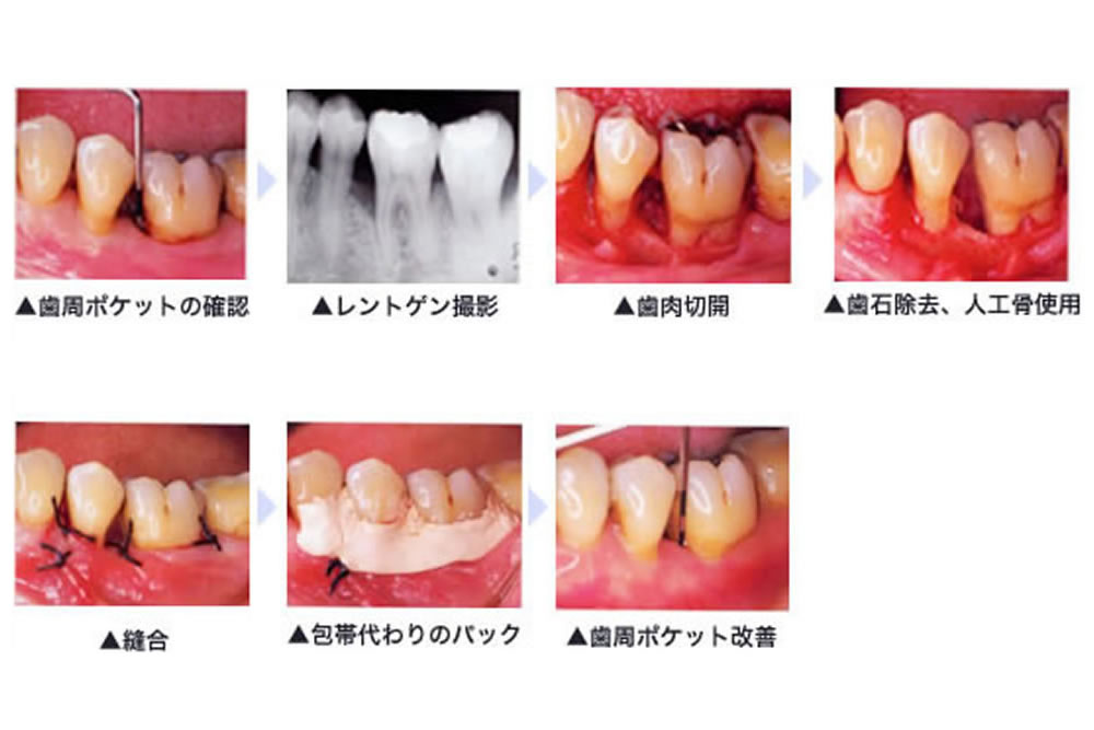 歯周病治療